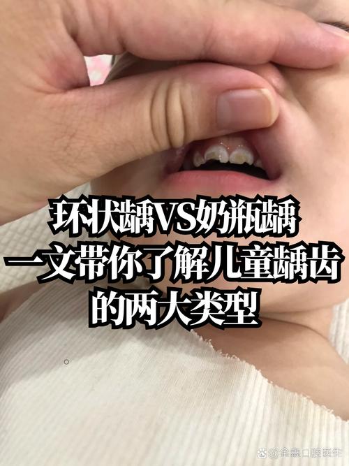 正畸磨牙后会坏牙吗-图2