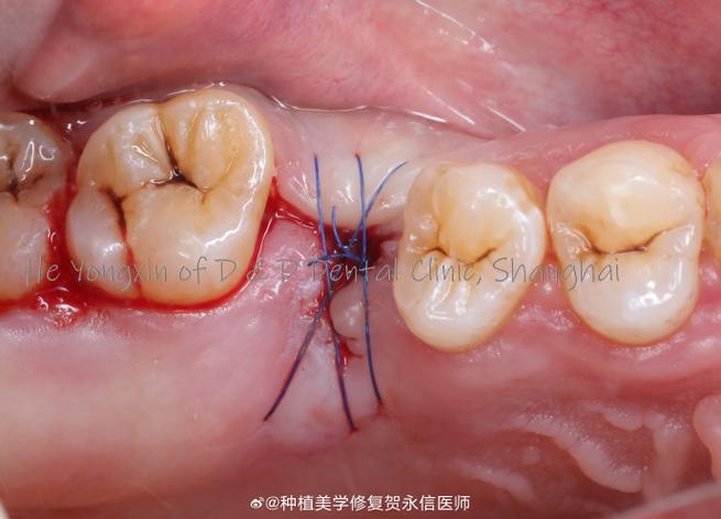 种牙后为何要缝线？对恢复有影响吗？-图1