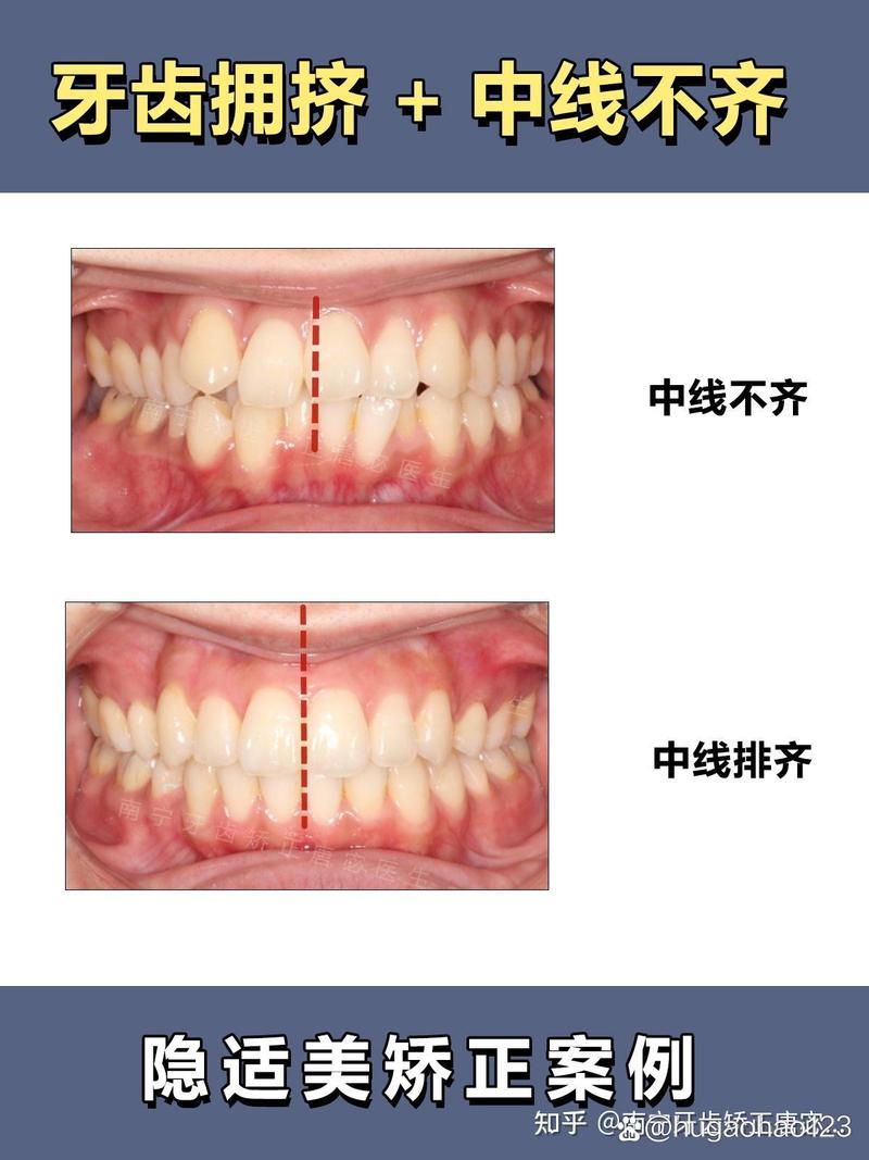 正畸中线偏移为何发生？如何有效矫正与预防？-图2
