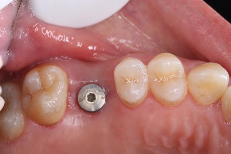 南京种牙修复怎么选?效果与价格靠谱吗?-图1 南京种牙修复怎么选?效果与价格靠谱吗?-图1