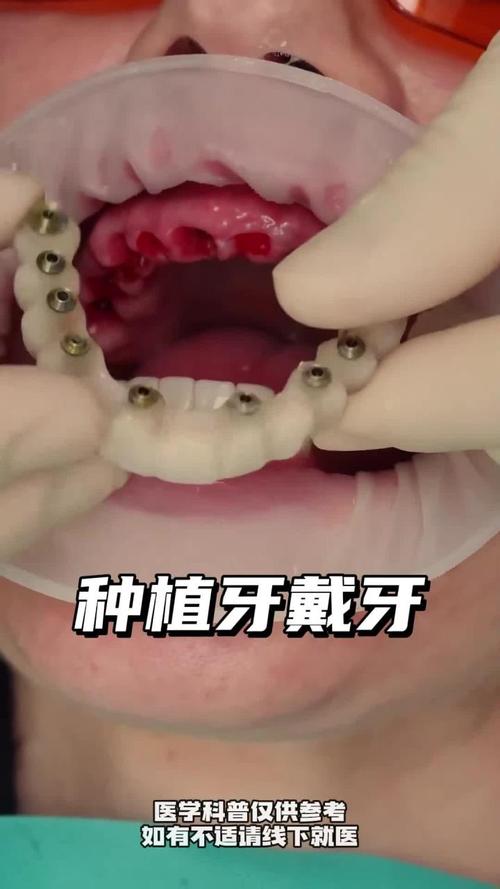种牙视频感想-图2 种牙视频感想-图2