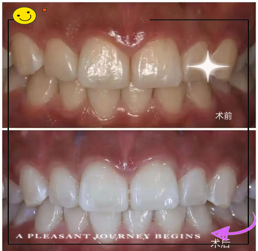 正畸矫正完冷光美白-图2