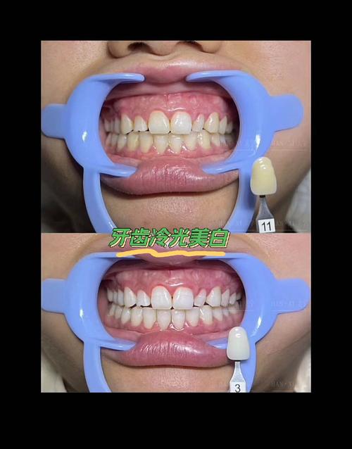 正畸矫正完冷光美白-图1