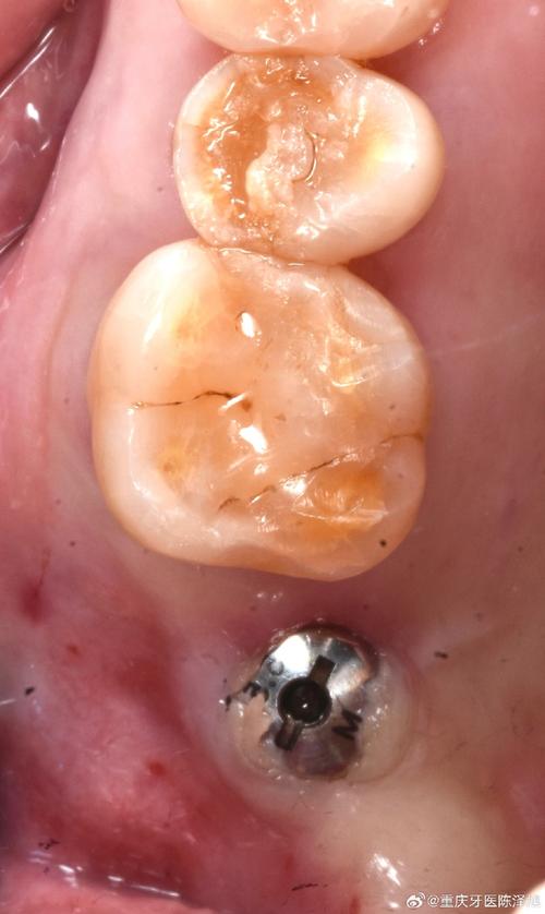 种牙切口恢复要多久？日常护理有哪些注意事项？-图1