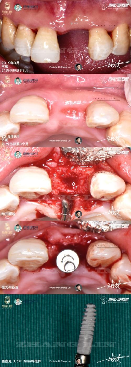 种牙切口恢复要多久？日常护理有哪些注意事项？-图3