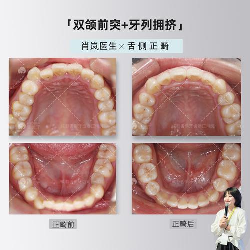 成都正畸详询华美6-图1 成都正畸详询华美6-图1