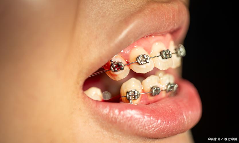 正畸保持牙周纤维带-图2