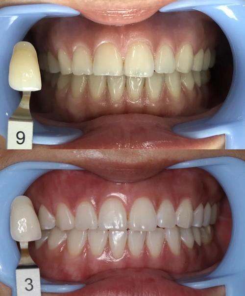 正畸后多久冷光美白-图2