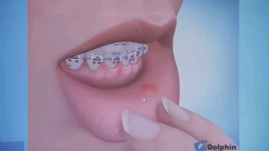 正畸取颌蜡，如何精准建立理想咬合关系？-图1