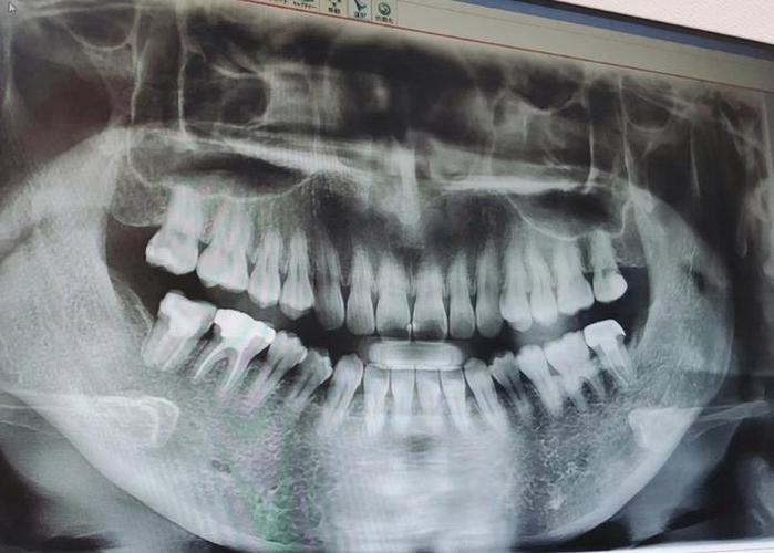 牙根短正畸，牙齿会脱落吗？-图3