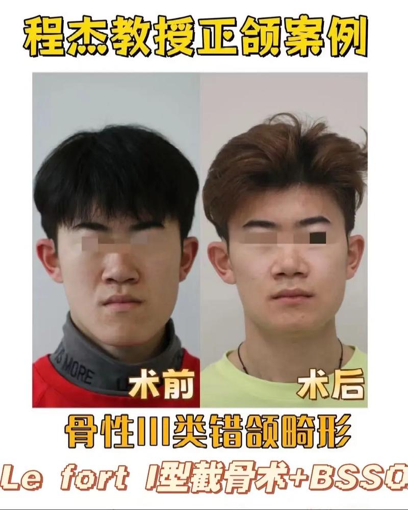 地包天正畸反弹案例，为何会复发？如何有效预防？-图1