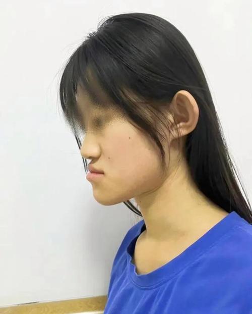 地包天正畸反弹案例，为何会复发？如何有效预防？-图2