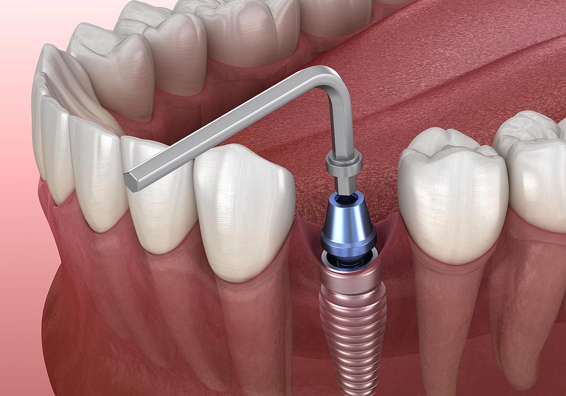 瑞典种牙技术-图3