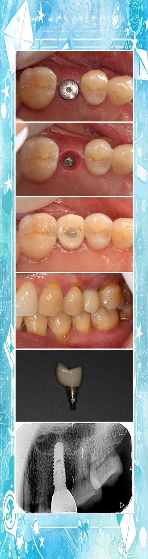 珠海惠民种牙-图1 珠海惠民种牙-图1