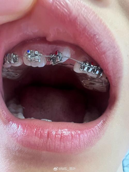 正畸的钢丝松掉了了-图2