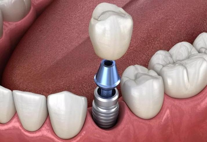 种牙就是假牙-图2