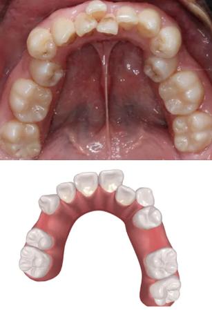 杀神经的牙还能正畸吗？-图1
