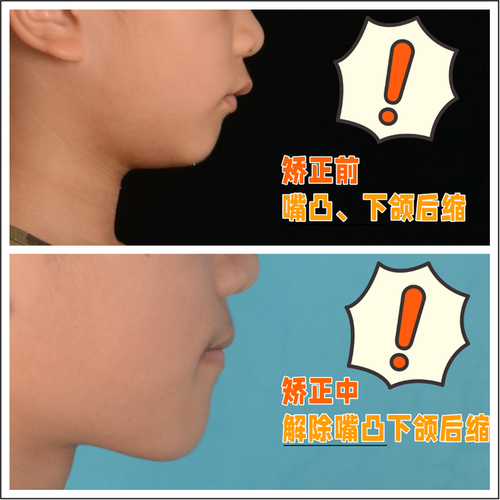 正畸唇舌肌训练抿嘴图有何具体作用？-图3