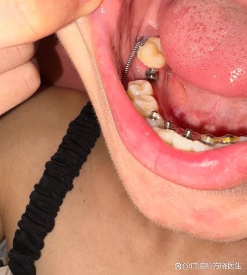 种牙术后发炎-图2