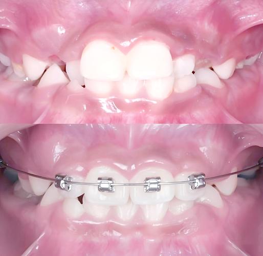 第二尖牙拔除后正畸-图2