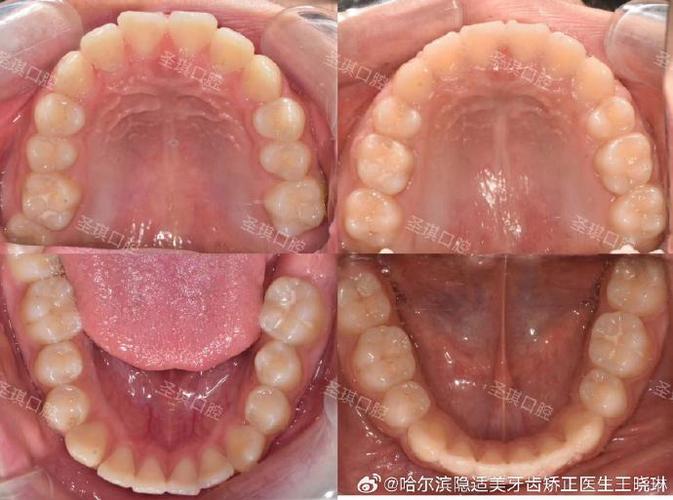 第二尖牙拔除后正畸-图1