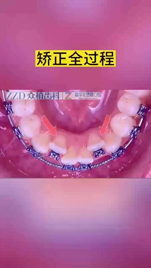 舌边牙齿正畸的过程-图1 舌边牙齿正畸的过程-图1