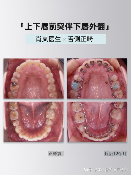 舌边牙齿正畸的过程-图2 舌边牙齿正畸的过程-图2