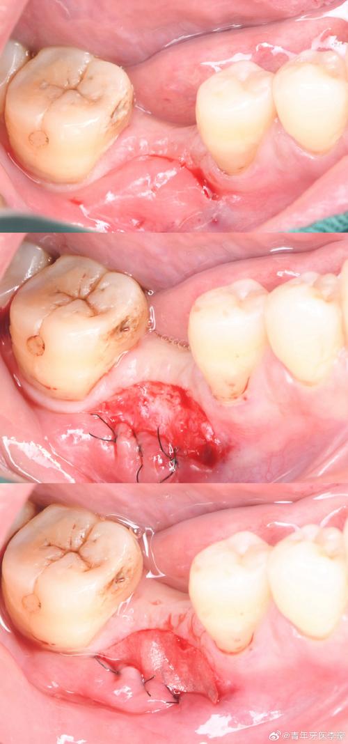 种牙磨牙图片展示磨牙过程吗？步骤有哪些？-图3
