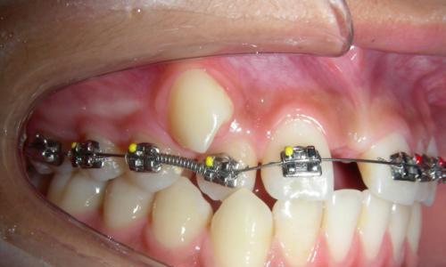 正畸弹簧的单侧受力-图2