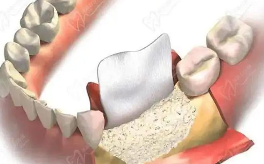 种牙 贴骨膜-图1