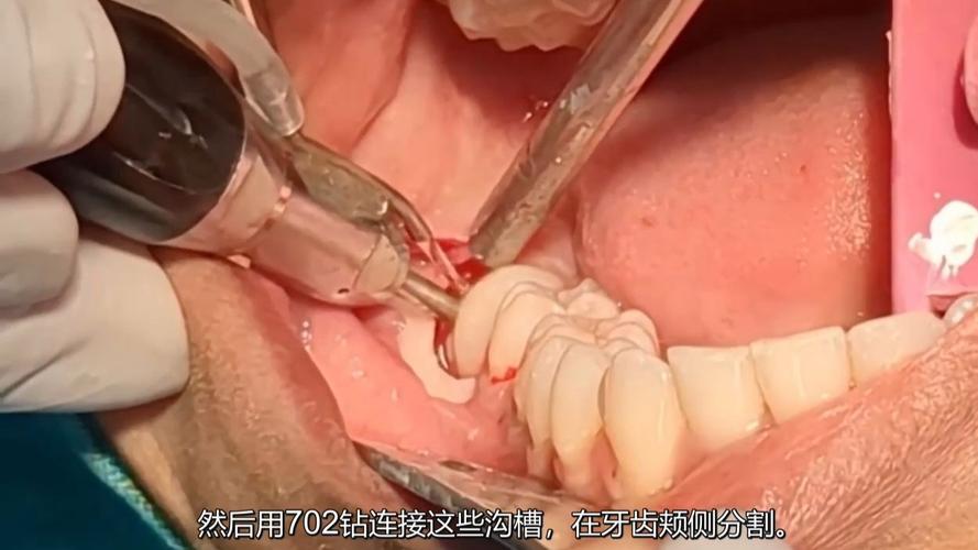 智齿拔除种牙-图1
