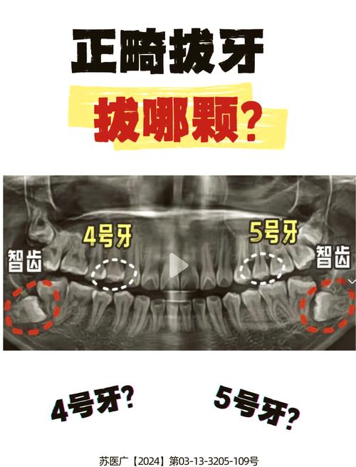 正畸拔牙要拔几颗牙-图3