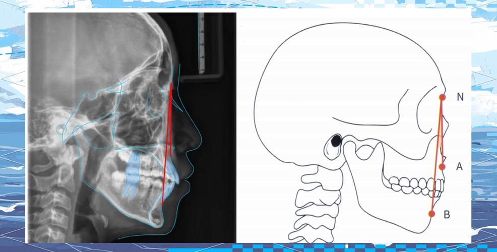 正畸anb角的正常值范围是多少？-图1