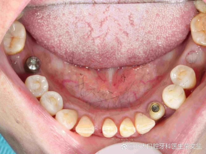 德国广州种牙-图2