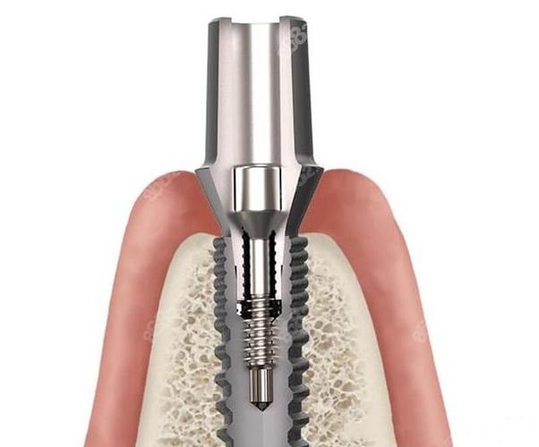 德国广州种牙-图1