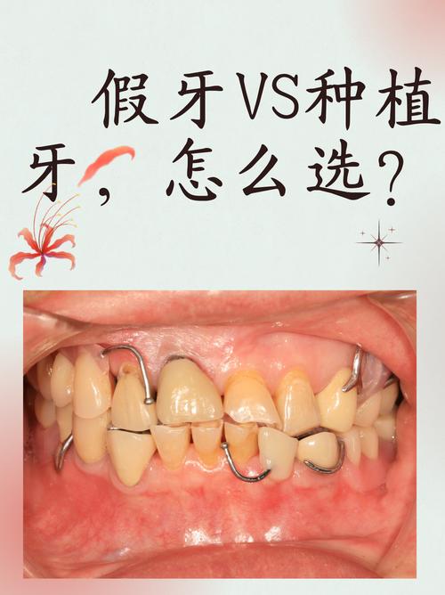 镶牙对比种牙-图1