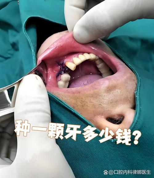 苏州医保能用于种牙吗？报销比例及政策如何？-图1