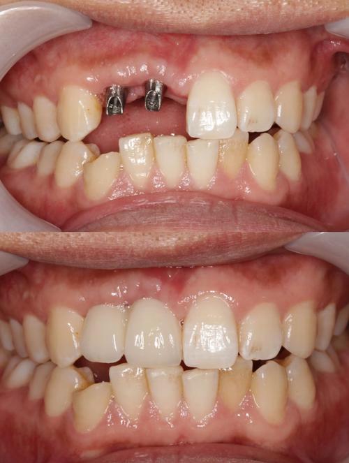 种植牙种太深-图1