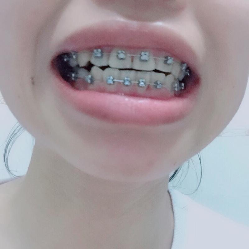 正畸复诊后牙齿不疼，是正常现象还是该警惕？-图3