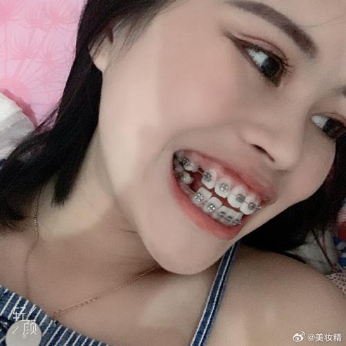 正畸复诊后牙齿不疼，是正常现象还是该警惕？-图2