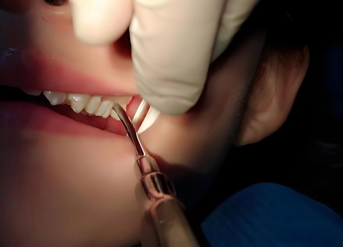 拔牙就能种牙-图1