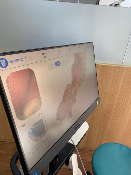 牙很齐牙缝大做正畸-图2