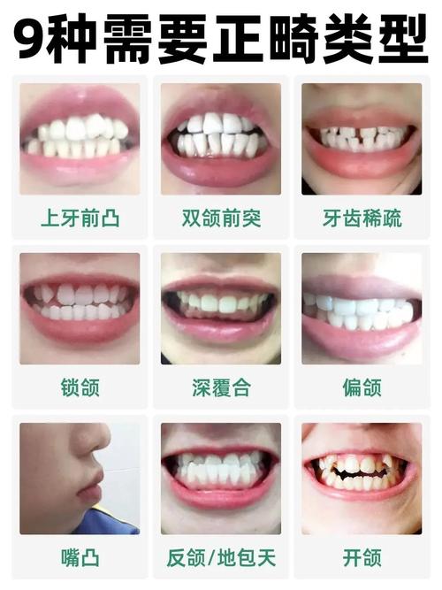 正畸牙是第几前磨牙-图2