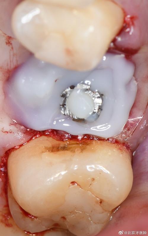 后牙即刻种牙-图2