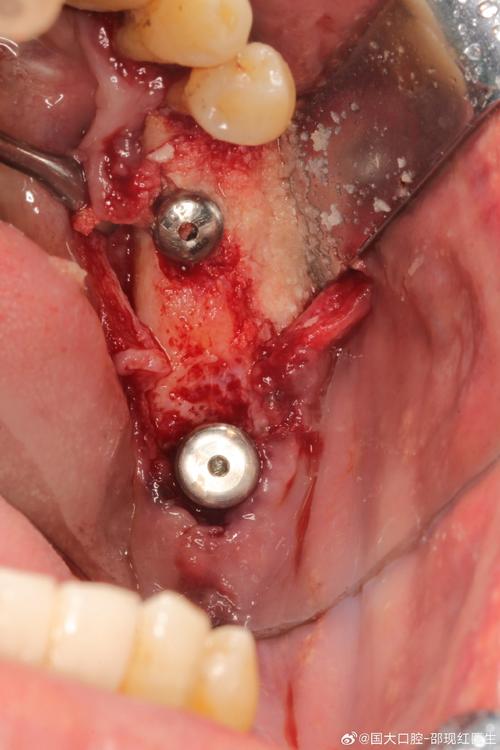 后牙即刻种牙-图1