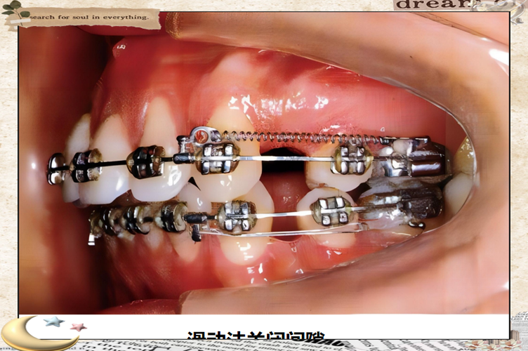 正畸关间隙弓形缩窄-图1
