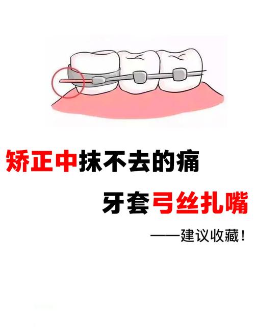 正畸弓丝怎么移动的-图3