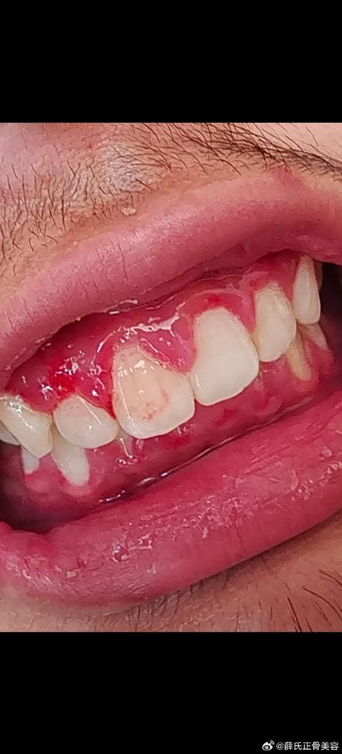 正畸过程中牙齿流血-图3