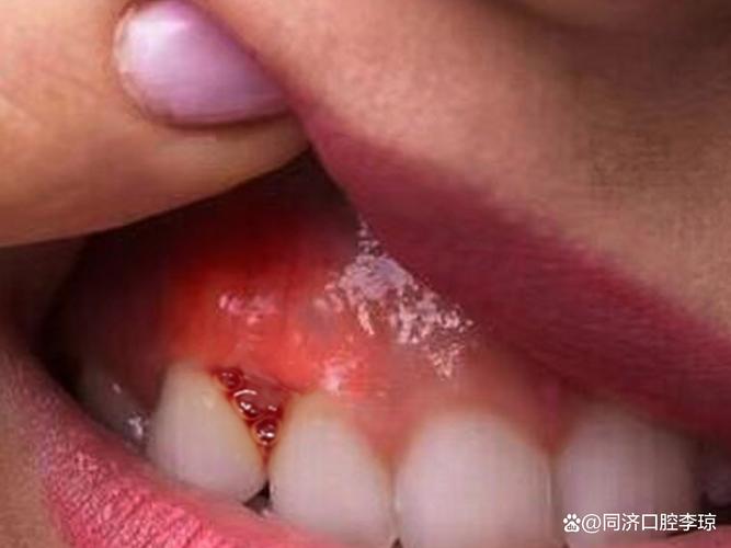 正畸过程中牙齿流血-图2