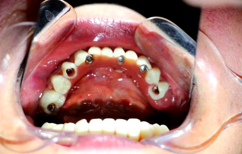 拔牙重新种牙-图1